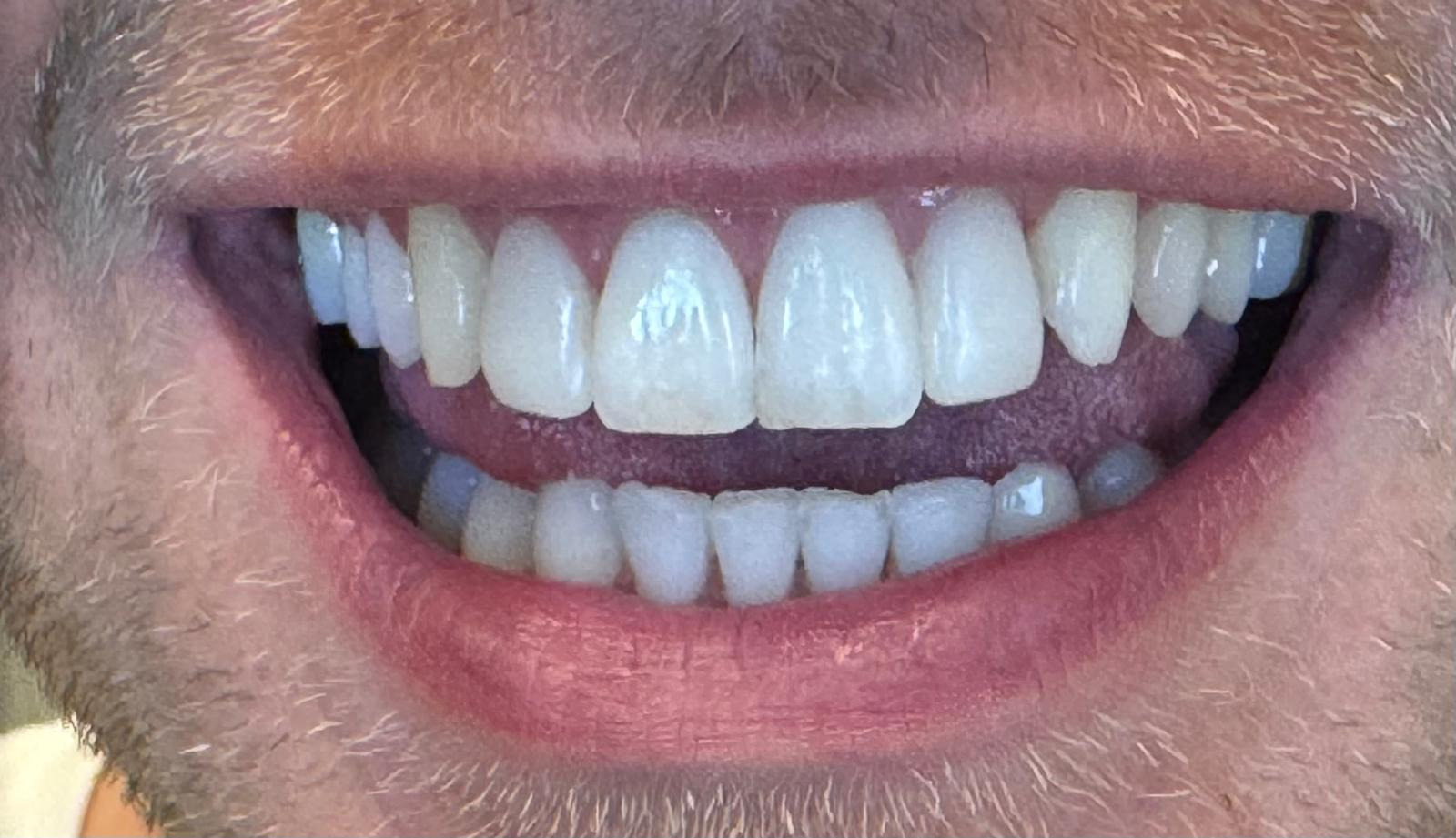 Before