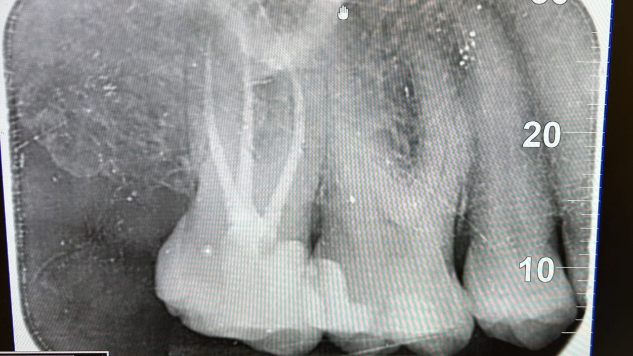 Upper right second molar