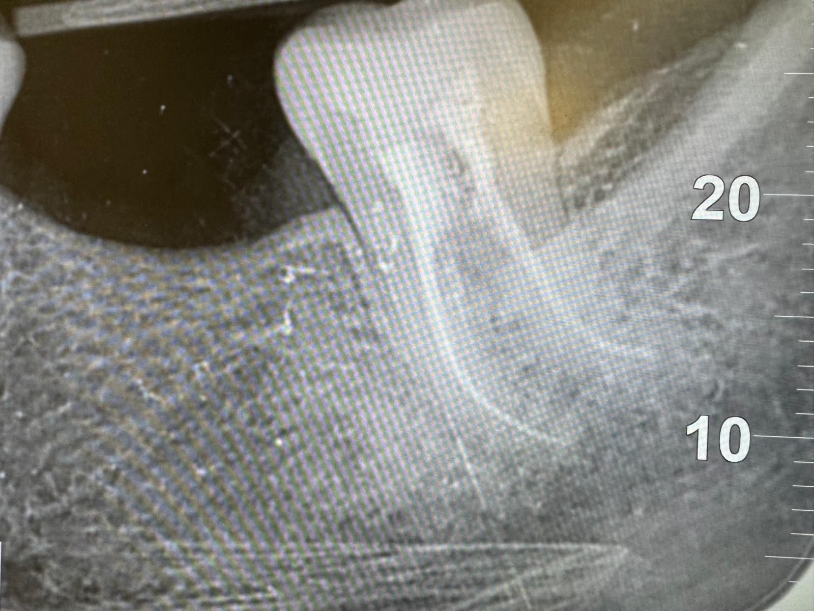 Lower left molar