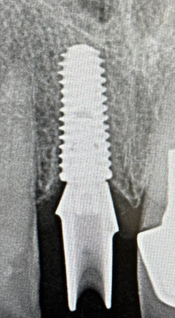 Book your Dental Implant Treatment with Beaulieu Dental Today!