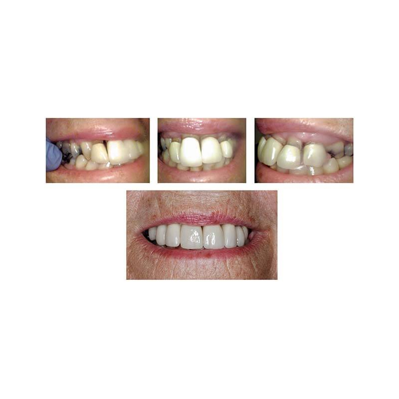 Replacement Crowns