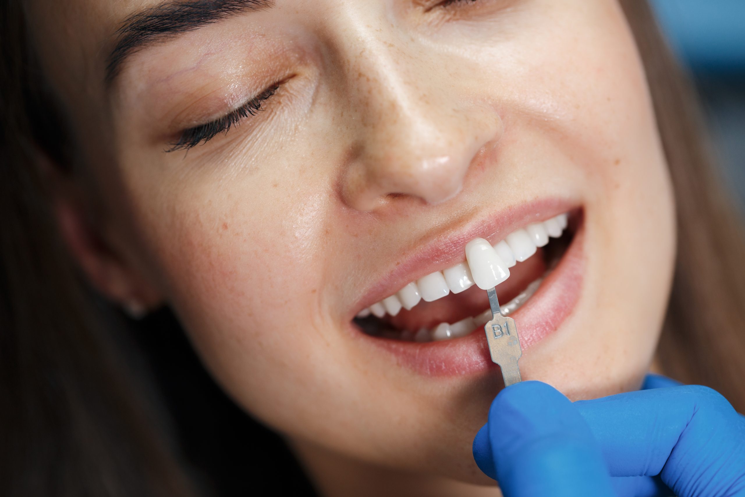Is Composite Bonding for you?