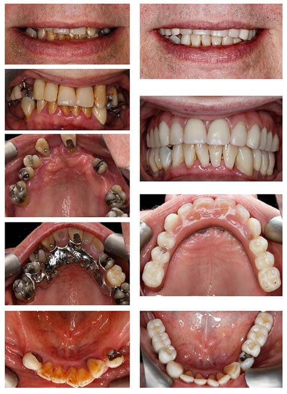 Teeth Straightening before/after