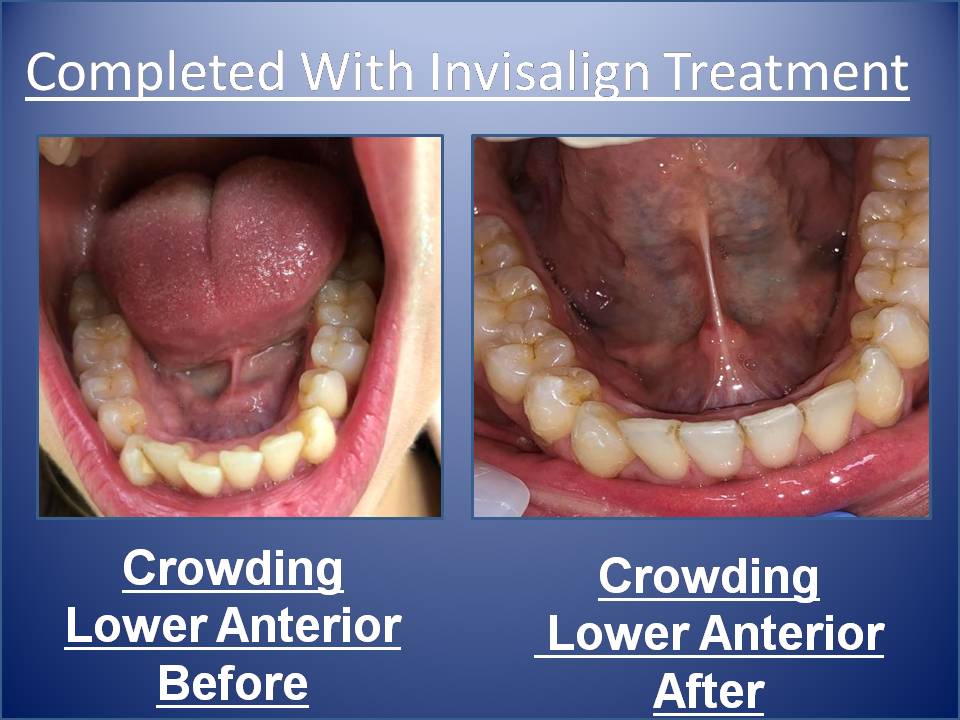 Teeth Straightening - before/after