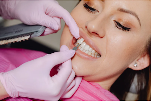What is the process for veneers? | Beaulieu Dental